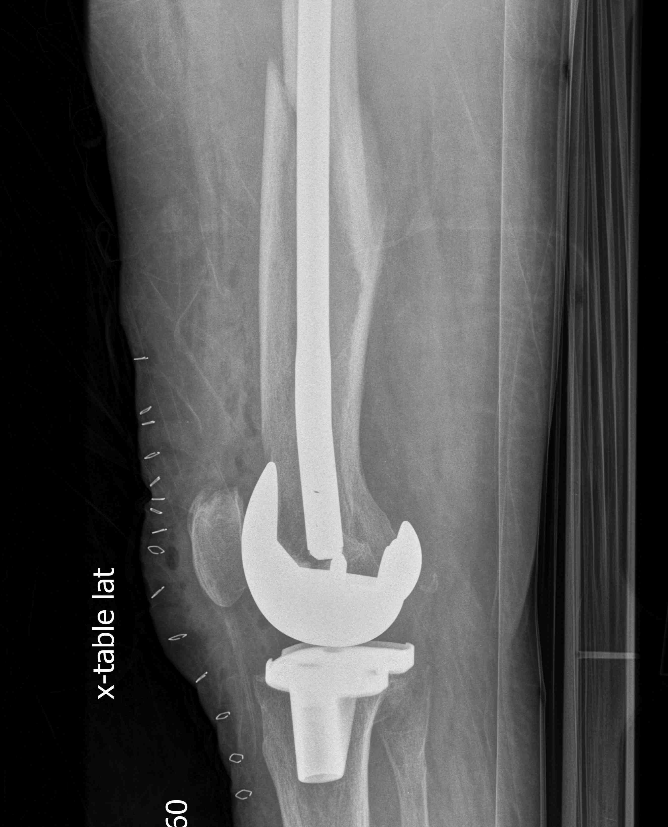 TKR Periprosthetic Fracture Retrograde Nail 2